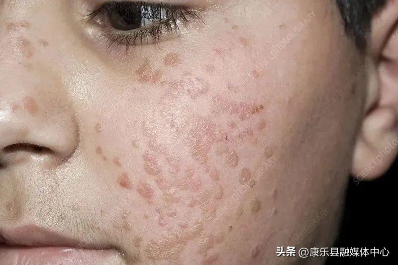 身上長了HPV，我們該如何面對與處理