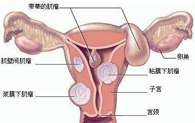 子宮肌瘤引起心臟不適子宮肌瘤引起心臟不適，癥狀、原因及應(yīng)對策略