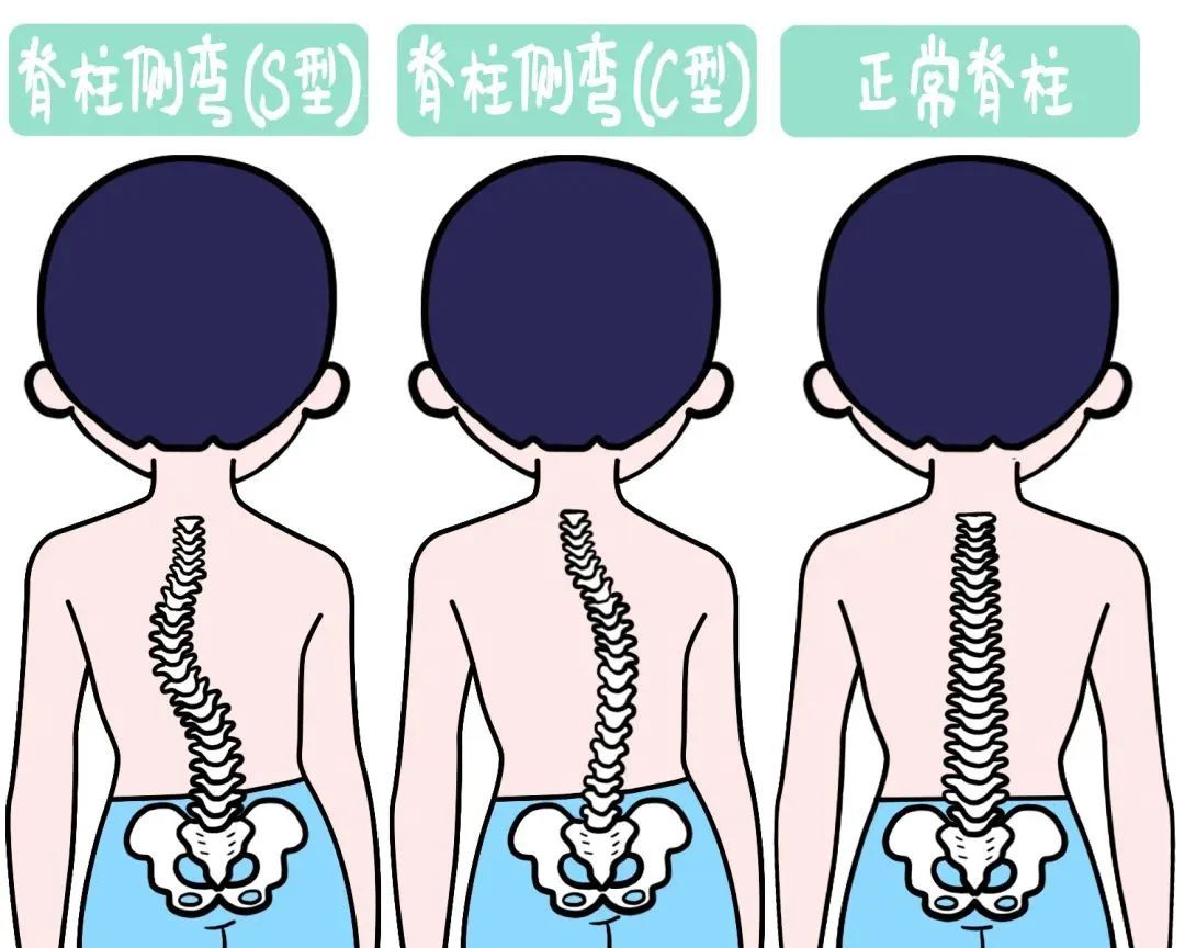 孩子“坐沒(méi)坐相”可能是脊柱側(cè)彎孩子坐沒(méi)坐相警惕可能是脊柱側(cè)彎，家長(zhǎng)必看！