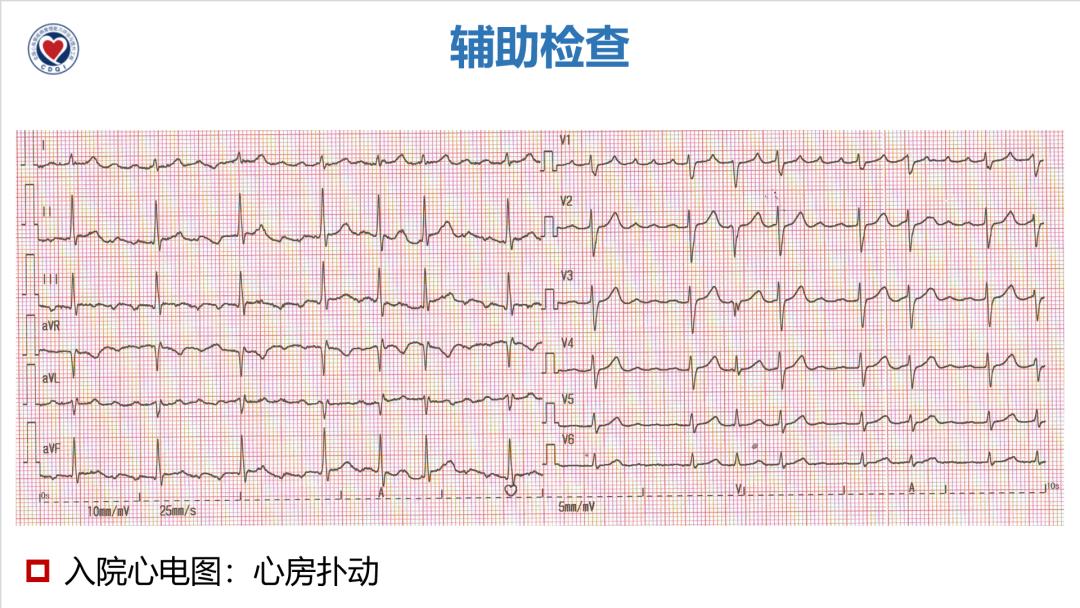 子宮肌瘤會引起心包積液嗎子宮肌瘤會引起心包積液嗎，深度解析