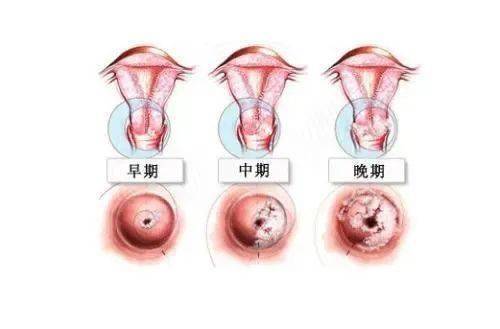 女子與男友戀愛后感染三種高危HPV女子與男友戀愛后感染三種高危HPV，警醒愛情背后的健康隱患