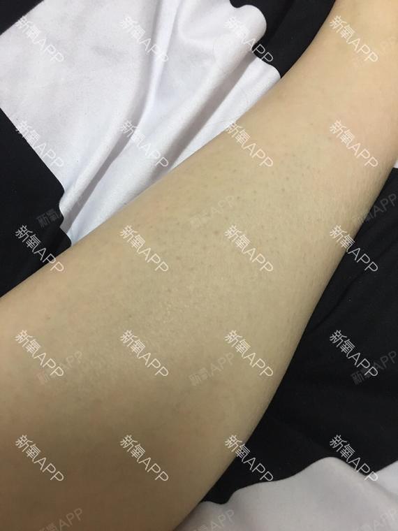 看了一眼激光脫毛儀的激光傷眼睛嗎激光脫毛儀的激光是否會傷害眼睛？深入了解真相