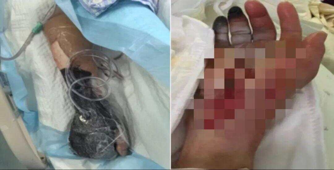 光腳踩到死魚進(jìn)ICU光腳踩到死魚引發(fā)意外，緊急送入ICU搶救