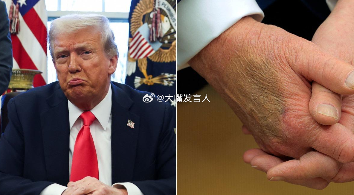 特朗普左手又添\"新淤青\" 白宮回應(yīng)特朗普左手又添新淤青，白宮回應(yīng)背后的故事