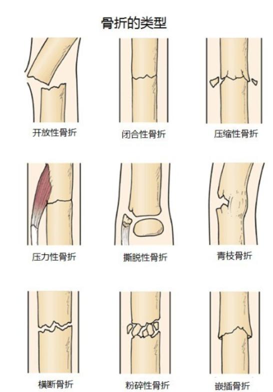 折斷的骨能夠痊愈主要與什么有關(guān)折斷的骨骼如何痊愈，深入了解骨骼再生與恢復(fù)的關(guān)鍵因素