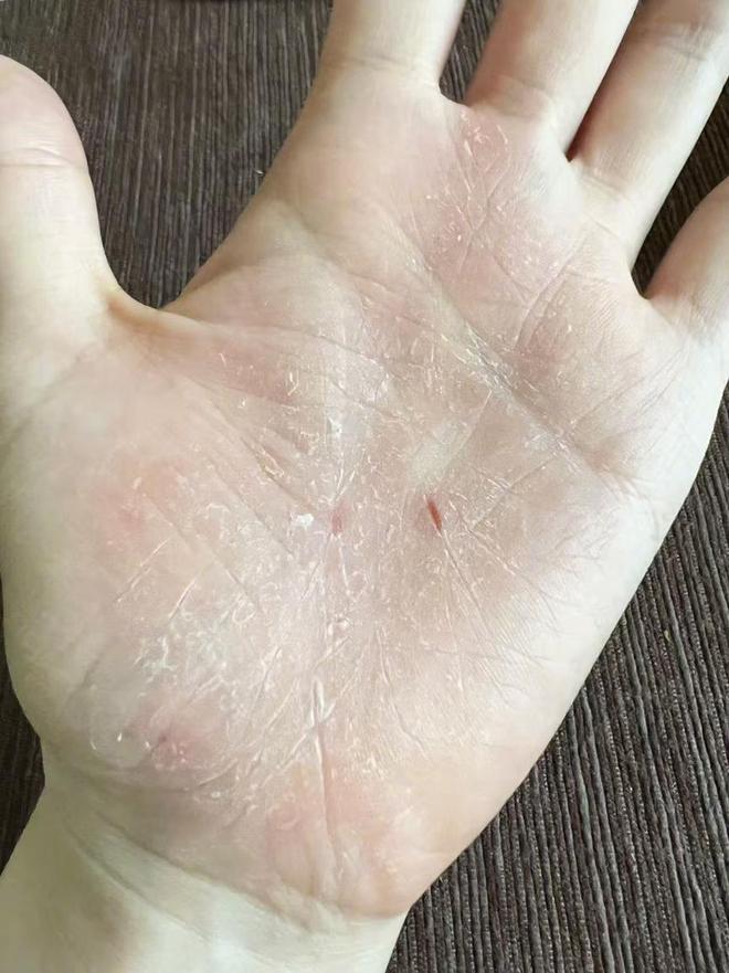 張靚穎一伸懶腰手掌就流血張靚穎一伸懶腰手掌就流血，神秘現(xiàn)象的背后真相