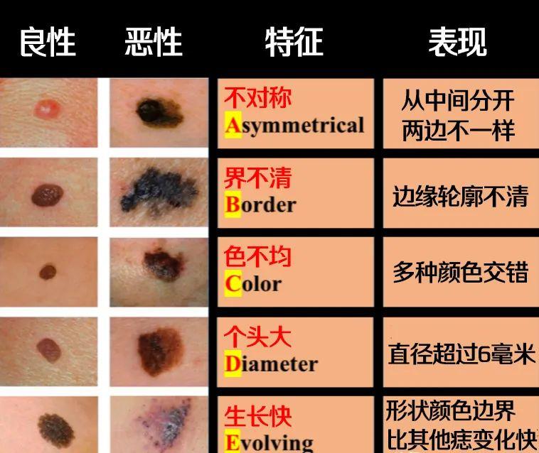 痣長在哪里最危險痣長在哪里最危險，解析危險痣相及其潛在風(fēng)險