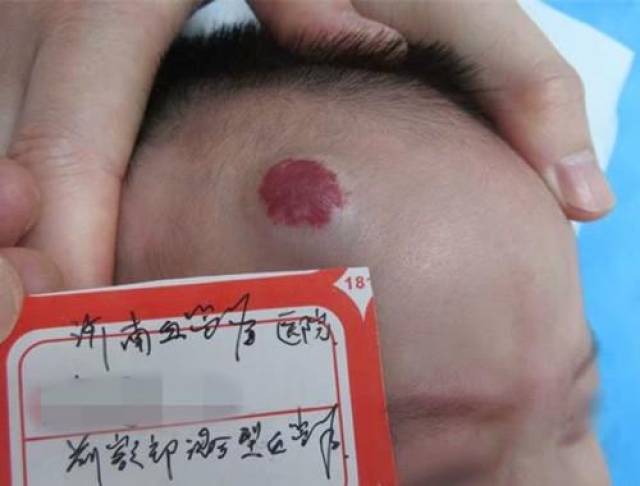 員工查出血管瘤要求不上夜班遭解雇自媒體揭秘，員工查出血管瘤要求調整工作被拒后遭解雇真相揭秘