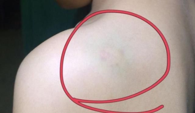 為什么女生身上容易青一塊為什么女生身上容易青一塊，探尋背后的原因