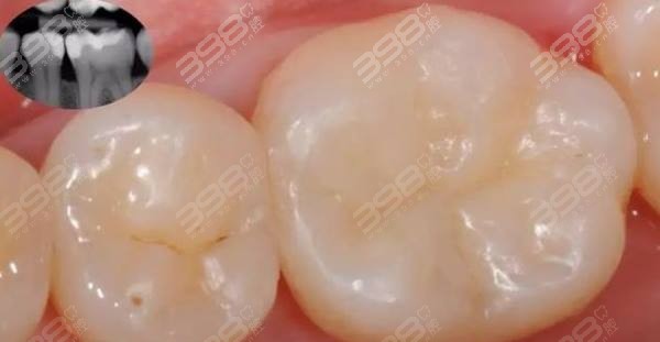 網(wǎng)上買的補(bǔ)牙洞材料怎么去除啊網(wǎng)上購買的補(bǔ)牙洞材料去除指南