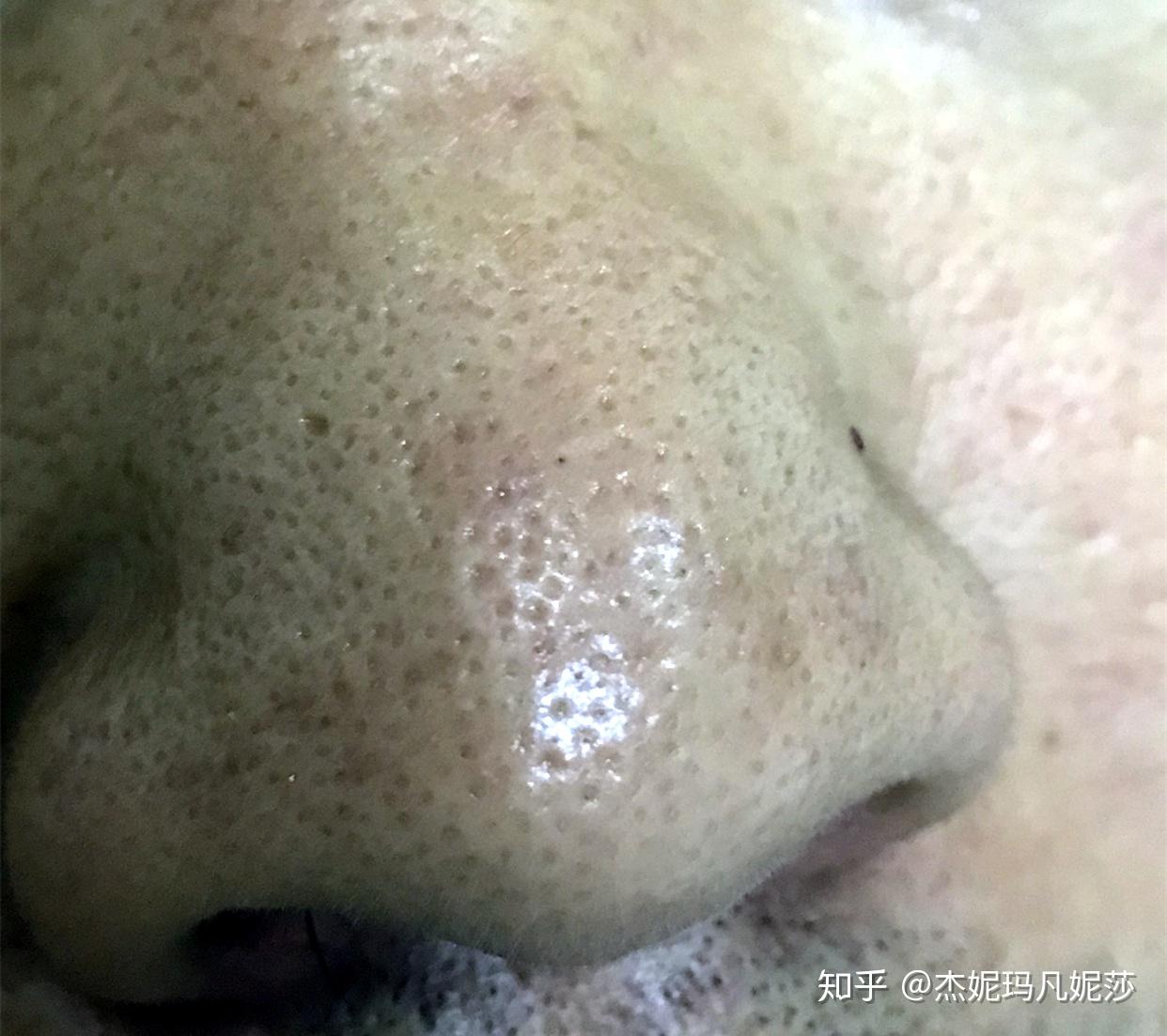 去黑頭導致毛孔粗大去黑頭導致毛孔粗大，原因、預防與解決方案
