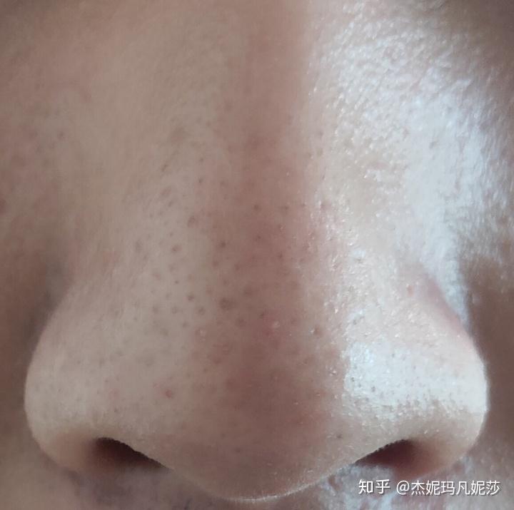去黑頭毛孔會(huì)粗大嗎去黑頭毛孔會(huì)粗大嗎？真相揭秘，讓你擁有無瑕肌膚！