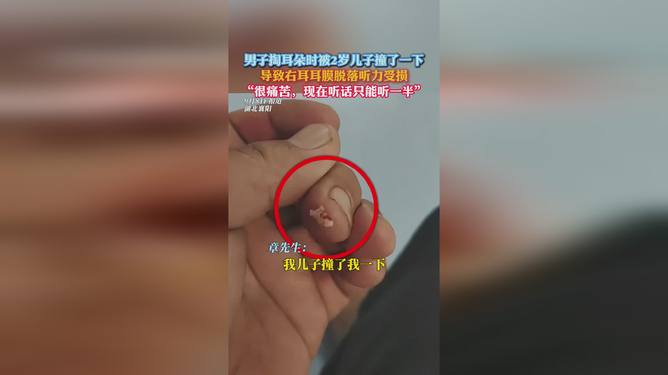 掏耳被撞致鼓膜脫落掏耳被撞致鼓膜脫落，深度解析與應對指南