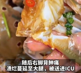 吃自制生腌蟹進ICU吃自制生腌蟹，進ICU的背后故事