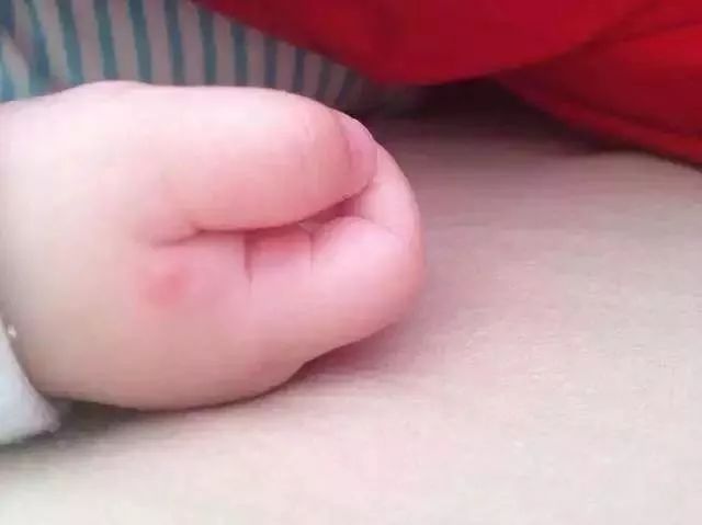 女?huà)朐庀x(chóng)咬全身?yè)Q血有用嗎女?huà)朐庀x(chóng)咬，全身?yè)Q血能否挽救生命？深度解析與應(yīng)對(duì)建議
