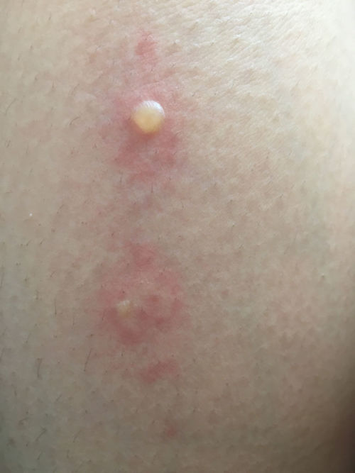 嬰兒被蟲咬了然后變成水泡了是怎么了?嬰兒被蟲咬后變成水泡的情況，可能是由于昆蟲叮咬引起的過敏反應所致。這種反應在醫(yī)學上稱為昆蟲叮咬性皮炎或蟲咬性皮炎。當昆蟲叮咬皮膚時，其唾液中的物質(zhì)可能引起皮膚的過敏反應，導致局部紅腫、瘙癢等癥狀。對于某些嬰兒，這種反應可能更為劇烈，形成水泡。