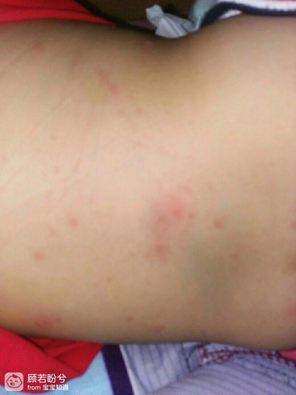 寶寶被蟲咬后全身起紅疹怎么回來寶寶被蟲咬后全身起紅疹怎么辦？全面解析應對之策