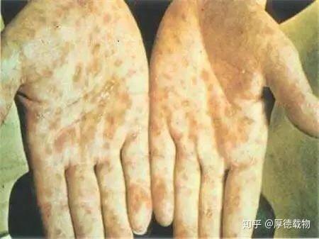 婚后發(fā)現(xiàn)丈夫瞞梅毒婚后發(fā)現(xiàn)丈夫瞞梅毒，如何應(yīng)對與重建信任？