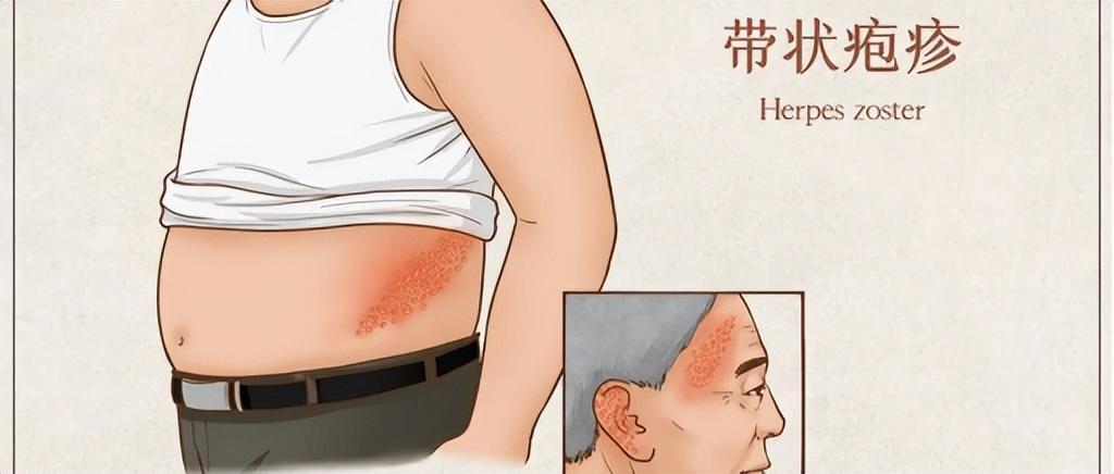 曝知名歌手患蛇纏腰曝知名歌手患蛇纏腰——深度解析與關(guān)懷