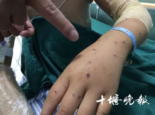 女童被蜜蜂蜇傷30分鐘后不幸身亡女童被蜜蜂蜇傷后不幸身亡的悲劇事件，深度分析與預防建議