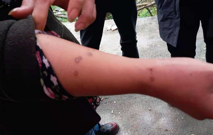 被蜂蜇30分鐘后身亡蜂蜇致命事件，了解蜂毒反應與緊急應對措施