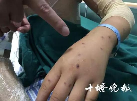 被蜂蜇30分鐘后身亡被蜂蜇后，某些情況下確實有可能導致嚴重的后果，甚至危及生命。蜂毒中含有多種生物活性物質，如肽類、酶類和生物胺等，這些物質在被人體吸收后可能引發(fā)一系列生理反應，導致嚴重的過敏反應或毒性反應。
