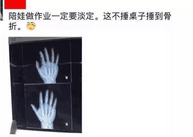 男子輔導(dǎo)兒子寫作業(yè)被氣到手骨折男子輔導(dǎo)兒子寫作業(yè)遭遇挫折，竟被氣到手骨折——家庭教育與心理健康的重要性