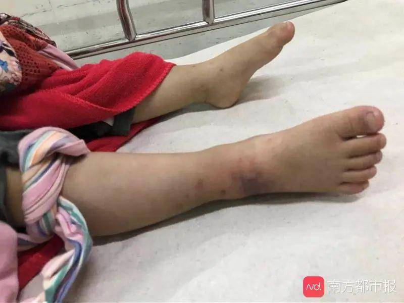 寶寶被蝮蛇咬傷 家長拎蛇飛奔醫(yī)院寶寶遭遇蝮蛇咬傷，家長冷靜應(yīng)對展現(xiàn)大愛，拎蛇飛奔醫(yī)院