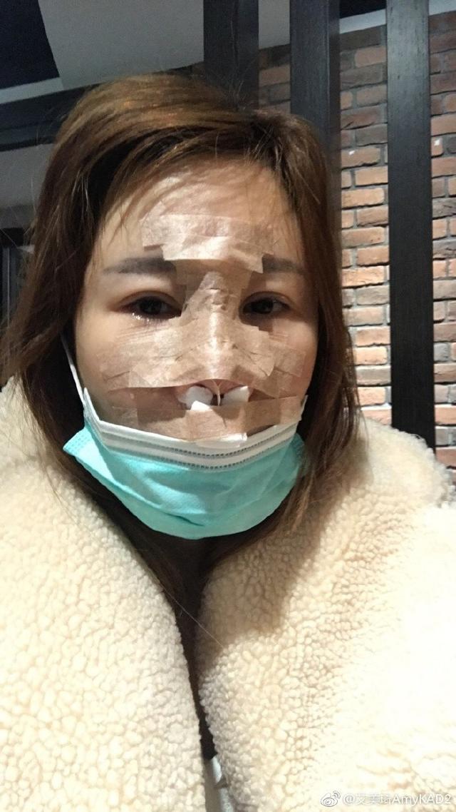 58歲女子整容后腫成熊貓一位中年女子的整容經(jīng)歷，從追求美麗到意外腫成熊貓