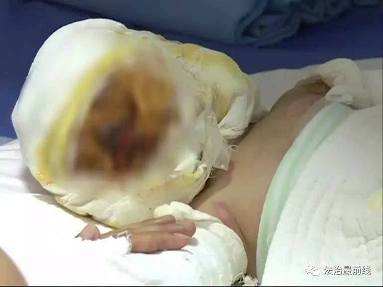 女童洗澡遭電擊致燒傷 為何如此嚴重？女童洗澡遭遇電擊致燒傷，事故背后的原因及其嚴重性探討