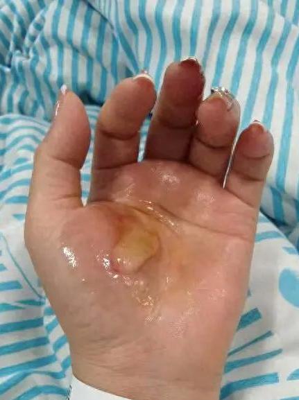 女童洗澡遭電擊致燒傷 為何如此嚴重？女童洗澡遭電擊致燒傷，悲劇背后的真相與預防
