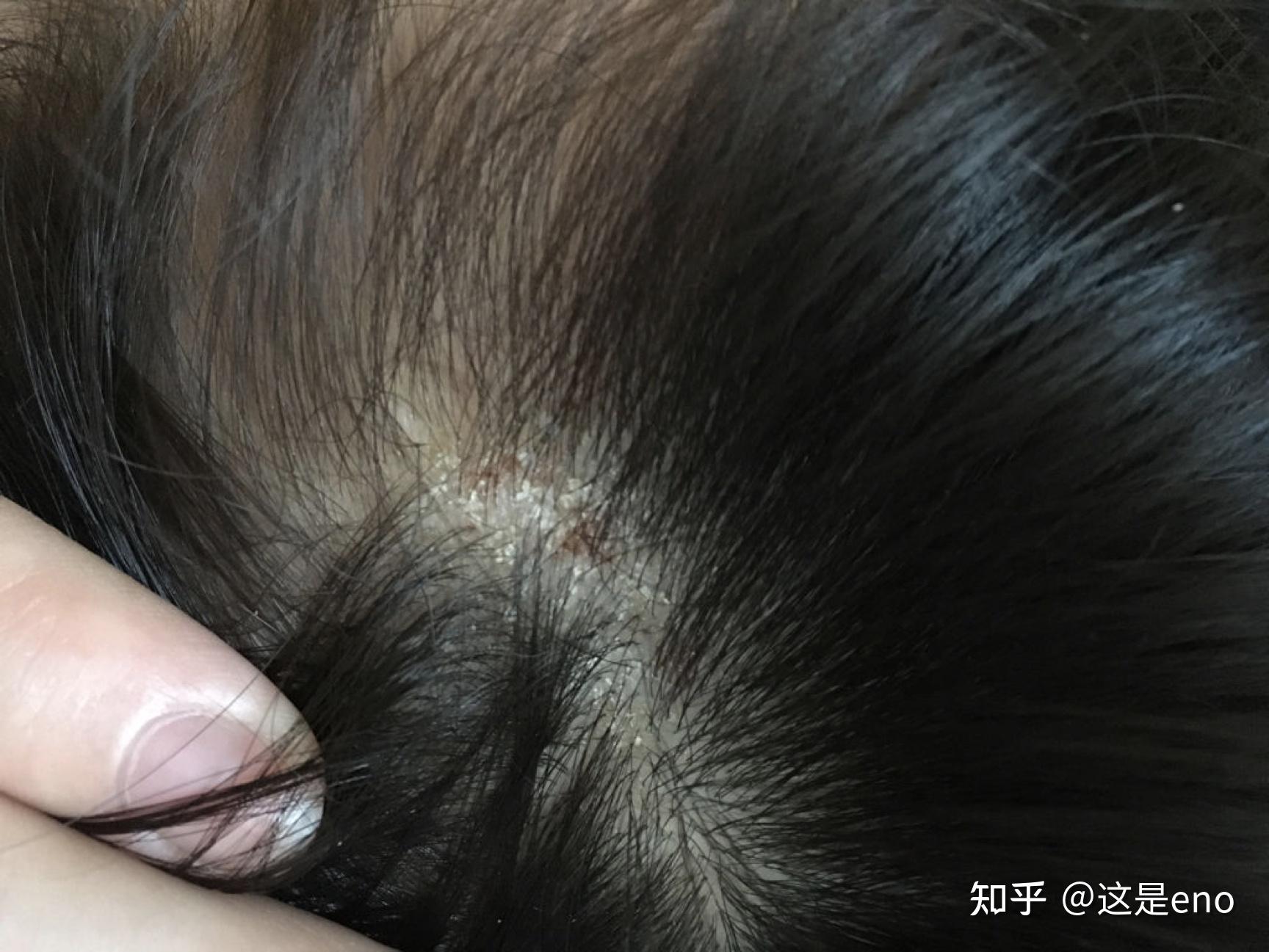 為啥頭皮上總會(huì)摳出來(lái)小顆粒揭秘，為何頭皮上總能摳出小顆粒的真相？