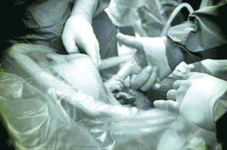 剖腹取嬰大懸案剖腹取嬰大懸案，揭示真相與深層思考