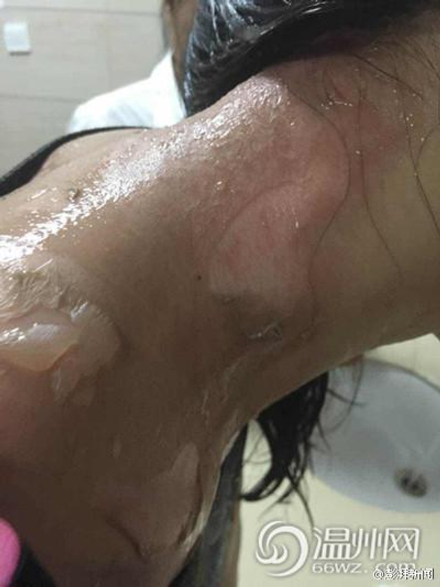 日料店服務員潑開水燙傷顧客這是一個非常嚴重的事件，涉及到顧客在日料店遭受不公正待遇和身體傷害的問題。如果這樣的事情確實發(fā)生了，應該采取以下措施